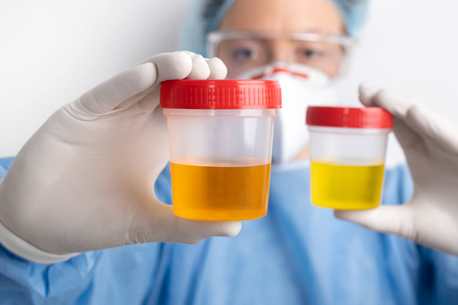 Análisis de orina usado para evaluar la función renal - Urine test used to evaluate kidney function.