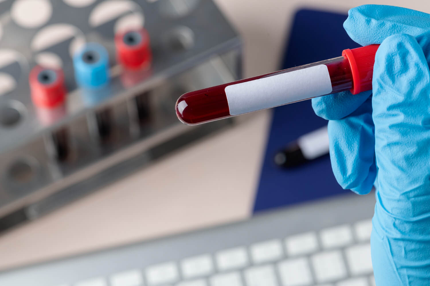 Análisis de plaquetas y hematocrito para diagnóstico de dengue - Platelet and hematocrit analysis for dengue diagnosis